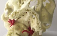 Mount Sinai Hospital Is 3D Printing Human Skulls